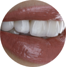 Aesthetical- Hollywood-smile