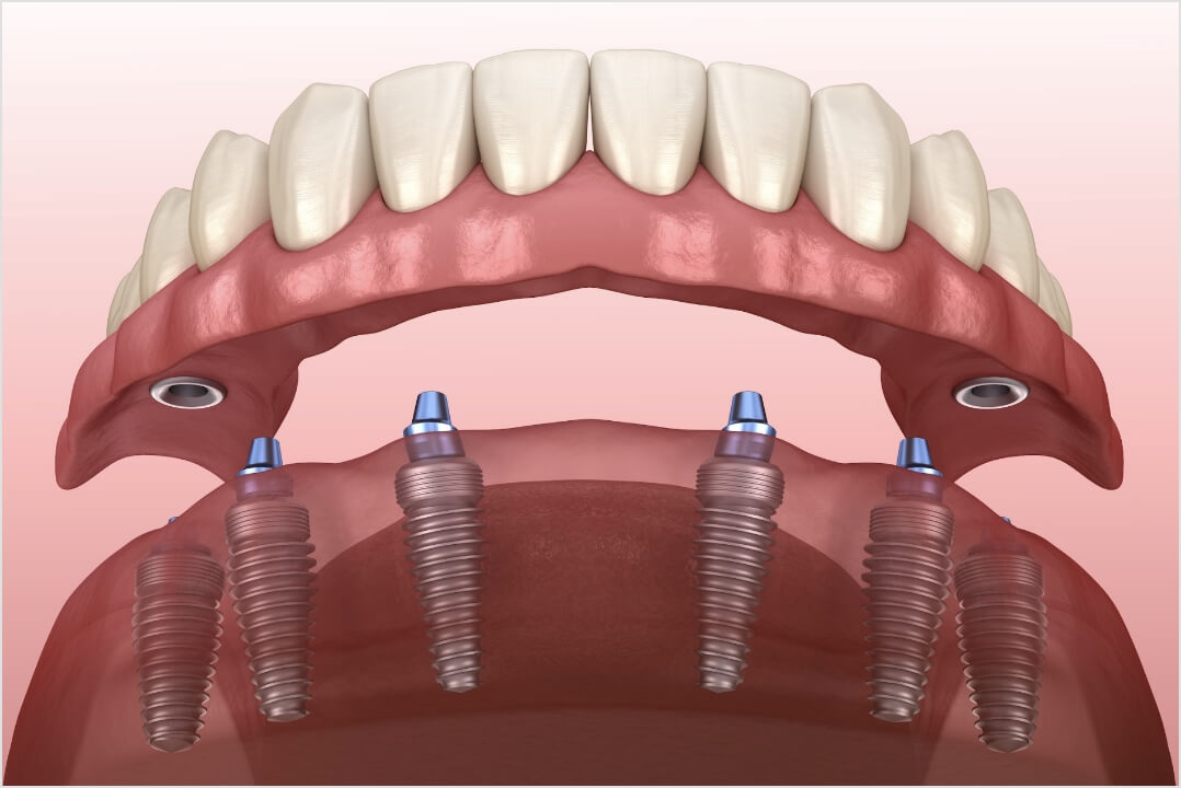 Aesthetical - The-All-on-6-dental-implant-procedure