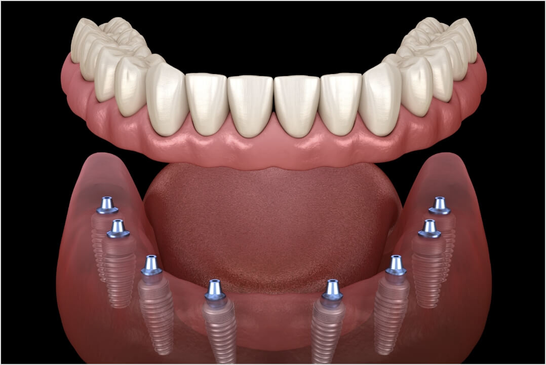 Aesthetical -The-All-on-8-dental-implant-procedure