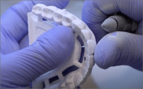 Aesthetical - Hybrid Prosthesis Image