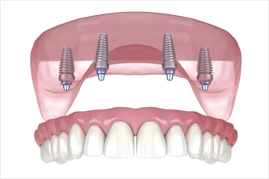 Aesthetical -implant-procedute