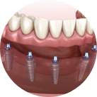 Aesthetical - Implants Technique