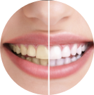 Aesthetical - teeth-whitening