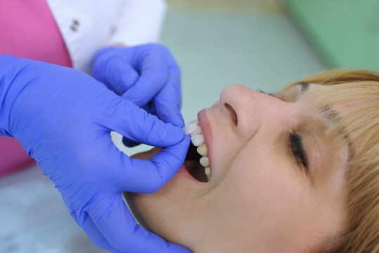 Aesthetical - veneers